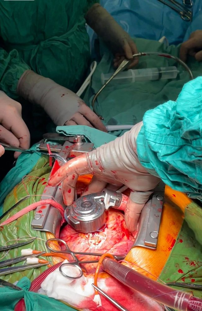 В Александровской больнице пациенту в сердце успешно имплантировали устройство для перекачки крови 04