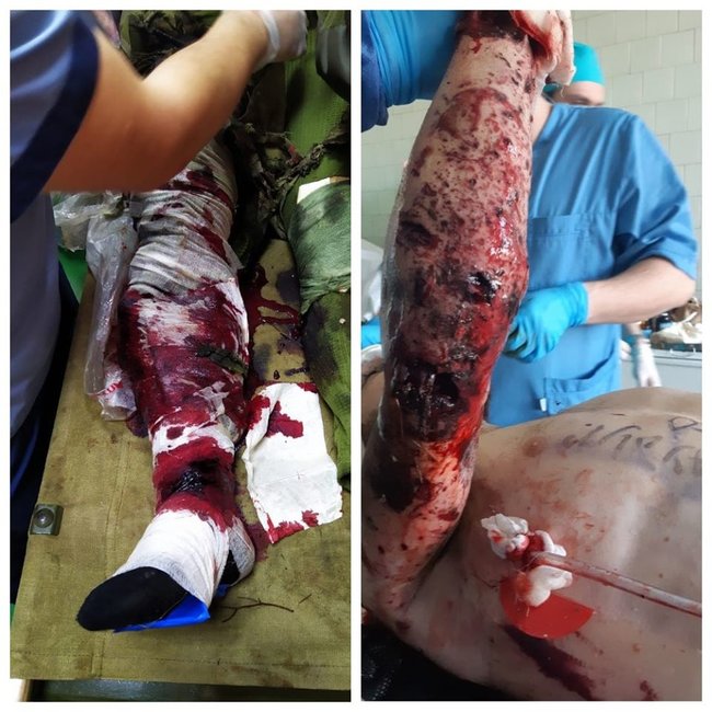 Атака оккупантов под Песками: журналист Цаплиенко показал ранения украинских воинов после попадания ПТУР в автомобиль ВСУ 01