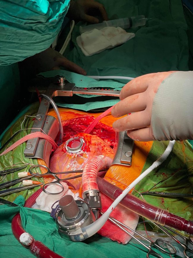 В Александровской больнице пациенту в сердце успешно имплантировали устройство для перекачки крови 03